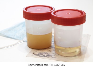 Urine jars on a white background, good and bad urinalysis. Disposable container for taking biomaterial