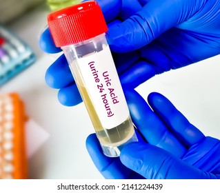 Urine Sample For 24 Hours Uric Acid Test