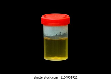 Urine Sample In Container Isolated On Black Background With Clipping Path, Bubble In Urine Specimen Mean Protein Found In A Urine Sample Known As Proteinuria, Determined By Urine Dipstick Test.