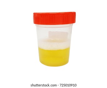 Urine Sample In Container Isolated On White Background With Clipping Path, Bubble In Urine Specimen Mean Protein Found In A Urine Sample Known As Proteinuria, Determined By Urine Dipstick Test.