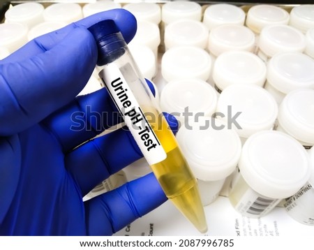 Urine sample container with sample for Urine pH test. To monitoring the kidney stones
