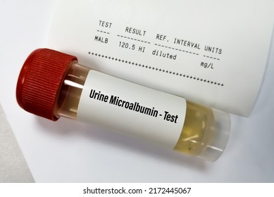 Urine Sample For Urine Microalbumin Test. Chronic Kidney Disease (CKD). Renal Function Test.