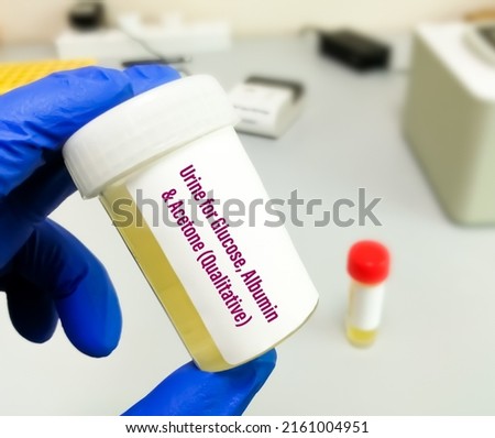Urine sample for the Qualitative analysis of Glucose, albumin and acetone.