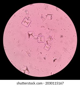 triple phosphate crystals in human urine
