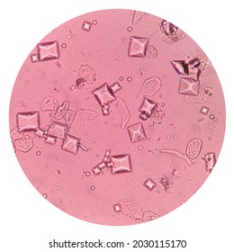 triple phosphate crystals in human urine