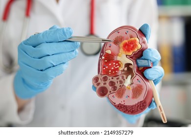 Urologist Pointing Pen Kidney Structure On Anatomical Model