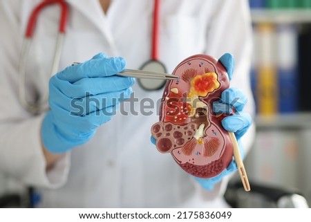 Urology and treatment of kidney diseases closeup