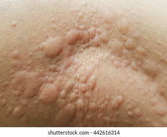 Urticaria 