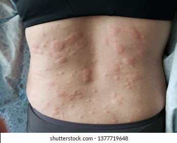 Urticaria or hives on the human back - Shutterstock ID 1377719648