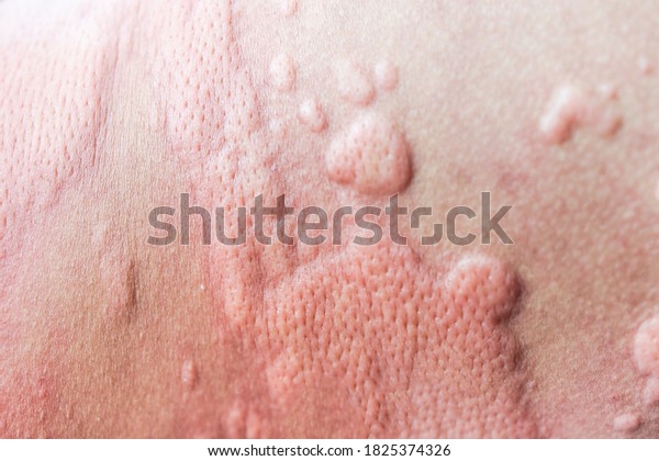 urticaria on skin. rashes, of which urticaria and\
toxic erythema are the most\
common.