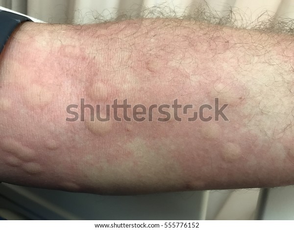 Urticarial Rash Drug Allergy Stock Photo (Edit Now) 555776152