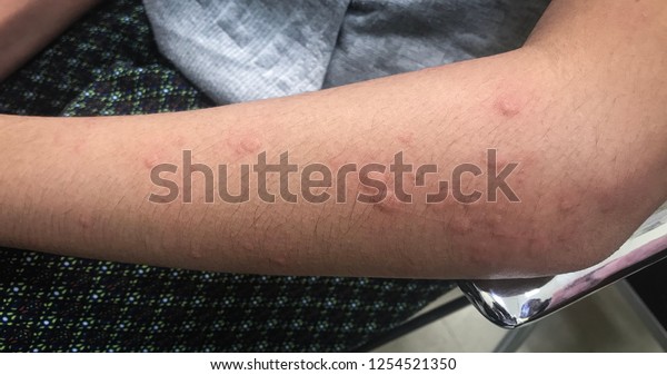 Urticarial Rash Left Arm Case Food Stock Photo Edit Now 1254521350