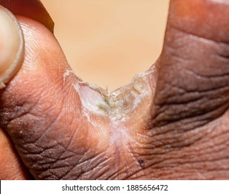 Using hands to expose chronic interdigital athlete's foot between middle and ring toe of a right foot of early thirties male. Dead layers of soft skin and erosions are visible due to long infection