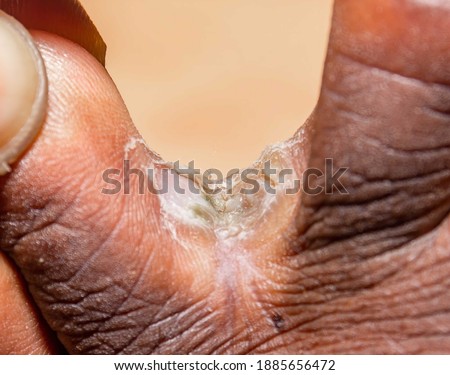 Using hands to expose chronic interdigital athlete's foot between middle and ring toe of a right foot of early thirties male. Dead layers of soft skin and erosions are visible due to long infection