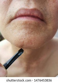 Ingrown Hairs Stock Photos Images Photography Shutterstock