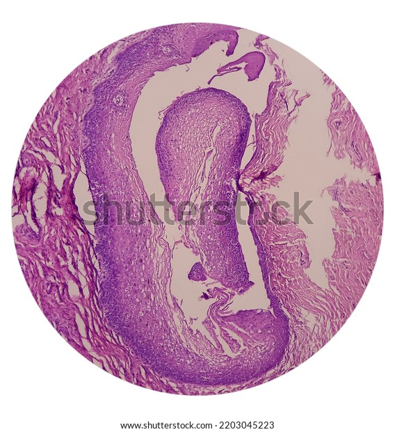 Uterus Biopsy Chronic Cervicitis Squamous Metaplasia Stock Photo ...