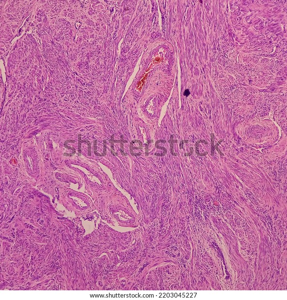 Uterus Biopsy Chronic Cervicitis Squamous Metaplasia Stock Photo ...