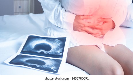 Uterus, Ovaries, Ovarian Cysts And Abnormalities In Cells, Close To Each Other, Woman Sitting  Closed To Her Stomach Because Of Abdominal Pain And A X-ray Film.