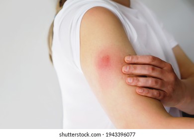 Vaccination Reaction On Arm Of Woman After Injection Of Covid Corona Virus Vaccine. Swollen Part, Red Puncture Site. Unrecognizable Person.