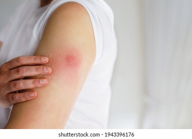 Vaccination Reaction On Arm Of Woman After Injection Of Covid Corona Virus Vaccine. Swollen Part, Red Puncture Site. Unrecognizable Person.