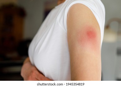 Vaccination Reaction On Arm Of Woman After Injection Of Covid Corona Virus Vaccine. Swollen Part, Red Puncture Site. Unrecognizable Person.