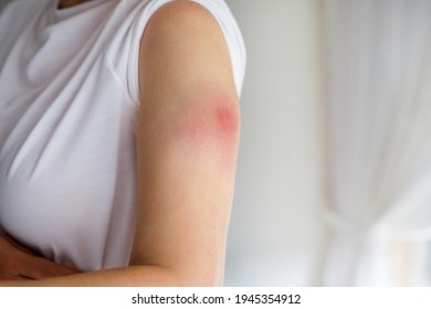 Vaccination Reaction On Arm Of Woman After Injection Of Covid Corona Virus Vaccine. Swollen Part, Red Puncture Site. Unrecognizable Person.