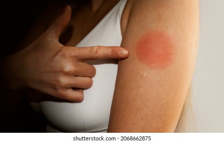 Vaccination Reaction On Arm Of Woman After Injection Of Corona Virus Vaccine, Woman Showing Swollen Red Reaction At The Injection Site.