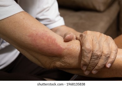 Vaccine Covid 19 Allergies Symptom In Elderly After Vaccination.