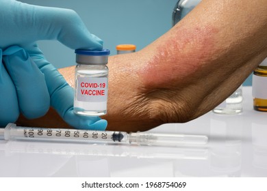 Vaccine Covid 19 Allergies Symptom In Elderly After Vaccination.