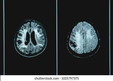 Vacular Dementia MRI Brain 