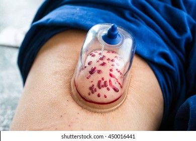 Vacum Blood Cupping With Bleeding Blood For Toxin Blood