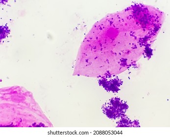 Vaginal Discharge Gram Stained Microscopic 100x Show Epithelial Cells And Neisseria Gonorrhoeae, Also Known As Gonococci Bacteria. Which Is Causes For Gonorrhea