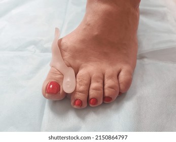 Valgus Deformity Of Foot And Fixator For Treatment. Bone On Big Toe Treatment And Causes Concept