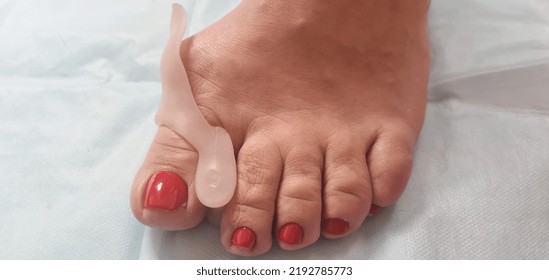 Valgus Deformity Of Foot And Fixator For Treatment. Bone On Big Toe Treatment And Causes Concept