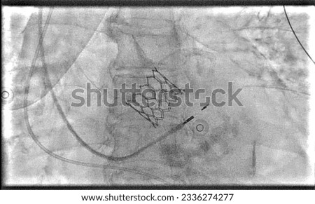 Valvular replacement with melody valve.