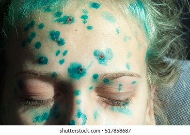 Varicella Zoster Virus Or Chickenpox Bubble Rash On Child, Baby Or Adoult. Closeup Image Of A Fresh Blister. Child With Chickenpox. 