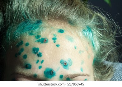 Varicella Zoster Virus Or Chickenpox Bubble Rash On Child, Baby Or Adoult. Closeup Image Of A Fresh Blister. Child With Chickenpox. 