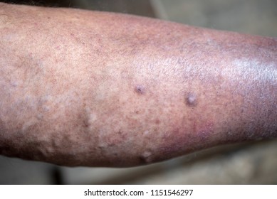 Varicose dark veins and blood vessels on the leg of an elderly man. The texture of dry sagging skin is visible closeup shot