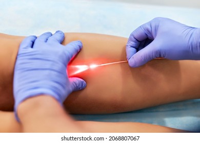 Varicose Laser Treatment On Female Legs In Clinic