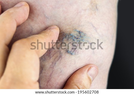 Similar – Image, Stock Photo Painful varicose and spider veins on womans legs, who is active at home. Two active seniors in the background. Vascular disease, varicose veins problems, active life concept.