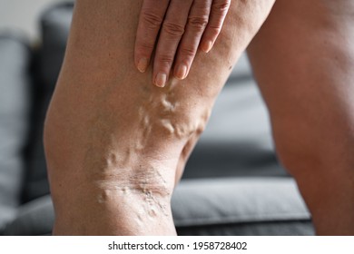 Varicose Vein Close Up Leg. Senior Woman Health Problem. Foot With Diseased Veins. Health Care, Podiatry.