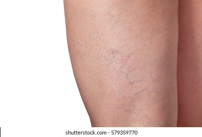 Varicose Veins And Capillary Veins In The Legs. Medical Inspection And Treatment Of Telangiectasia.