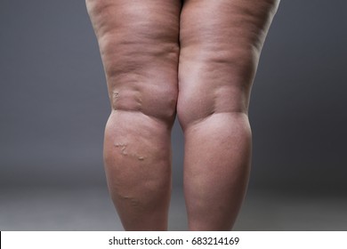 Ssbbw Fat Legs