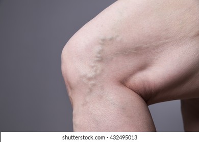 Varicose veins closeup. Thick female legs on a gray background