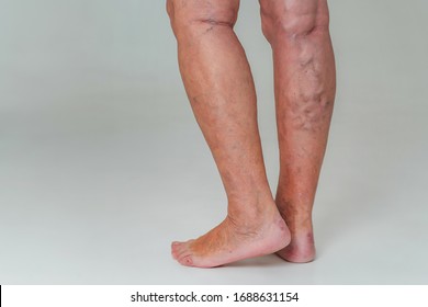 Varicose veins in an elderly woman. Inflamed dilated veins in the legs. Varicose veins in the late advanced stage.