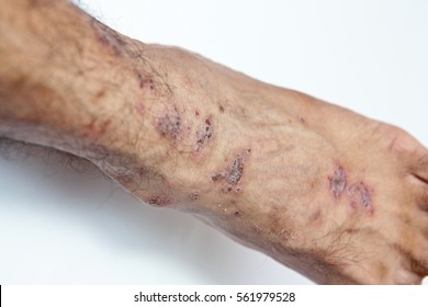 eczema cu fotografie vector de varicoză