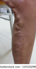 Varicose Veins of Leg. arising from Long Saphenous Vein.