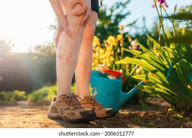 Varicose veins and leg diseases. A woman holds her hands on a sick leg with vascular asterisks, close-up. Outdoors. The concept of vascular diseases.