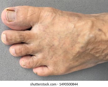 Varicose Veins are normal veins near the enlarged skin layers that swell.  And there is so much blood accumulating that you can see the blue or dark purple veins  Varicose veins are often on the legs  - Shutterstock ID 1490500844