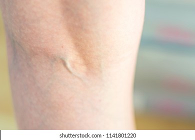 Foot warts needle